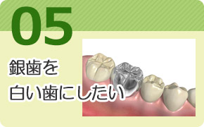 銀歯をセラミックに・審美歯科