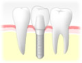 インプラント